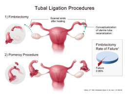 tubal-ligation